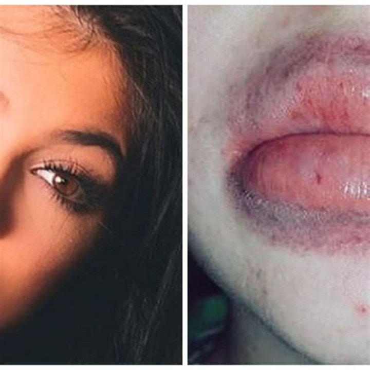 The Truth About Kylie Jenner Lip Challenge: Risks And Remedies Revealed