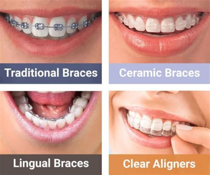 Uncovering The Allure Of "Braces That Look Like Grills"